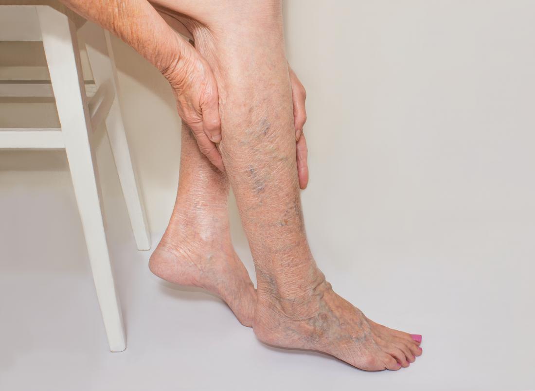 What Are The Causes, Treatment, And Prevention Of Spider Veins?